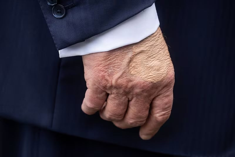 Analysis of Trump's Recent Medical Incident: Bruising, Swelling, and the Epstein Files Connection